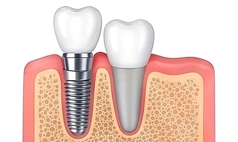 Dental Implant in Oman