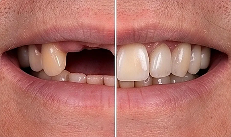 Replacement of Teeth in Oman