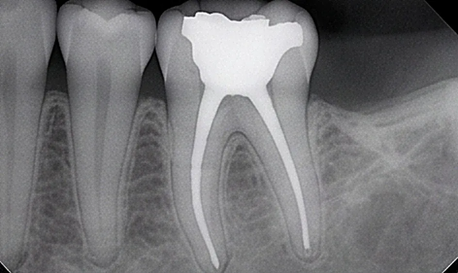 Root Canal in Oman
