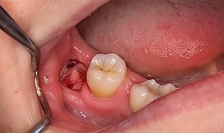 Surgical Extractions in Oman