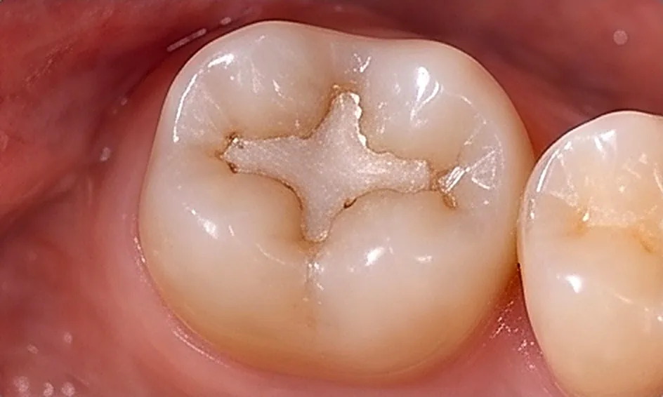 Teeth Fillings in Oman