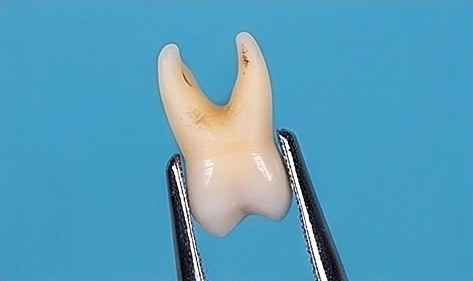 Teeth Removal in Oman