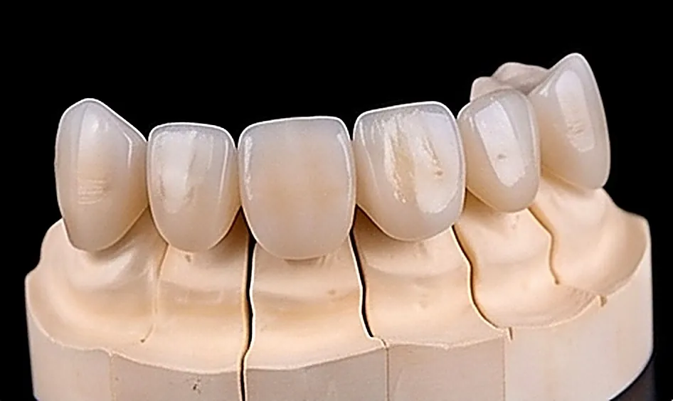 Veneers Zirconium Bridges in Oman